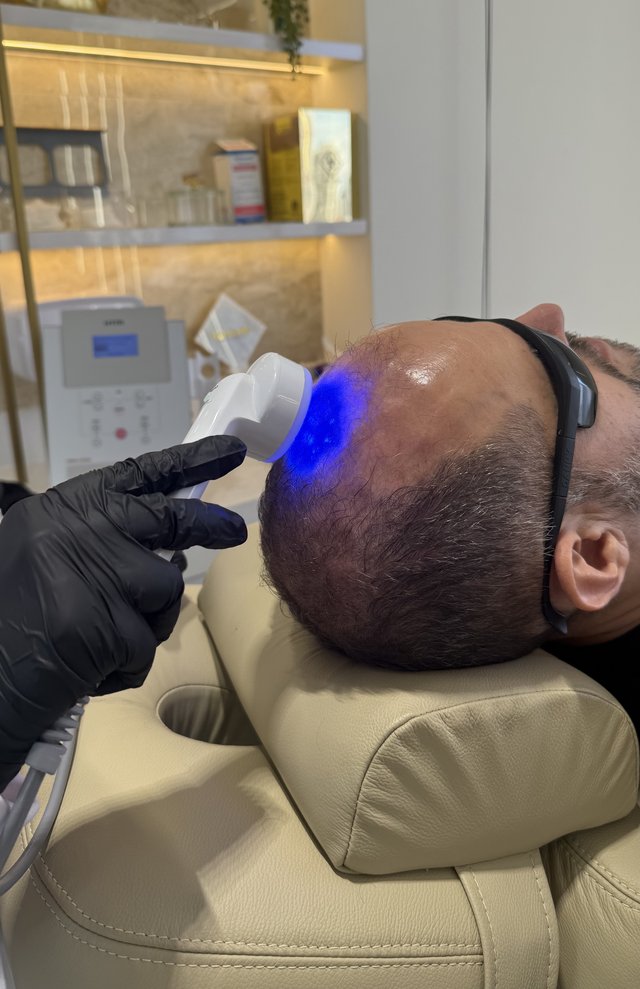 Tratamento Capilar a Laser